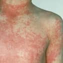 After 12 to 48 hours the characteristic fine red rash of scarlet fever develops