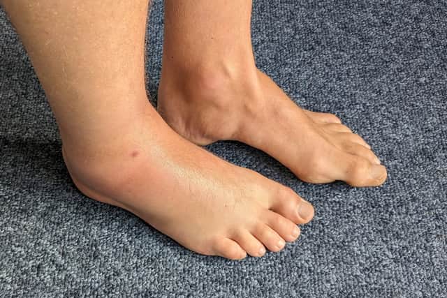 Chris Laing’s ankle after the snake bite